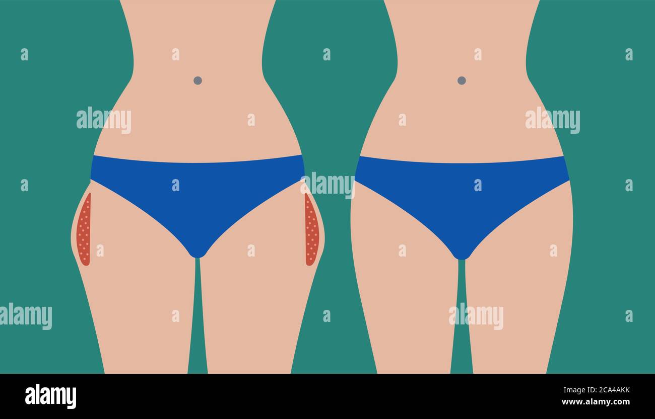 Hip liposuction, hip correction before and after. Exercises for local fat removal. Vector illustration Stock Vector
