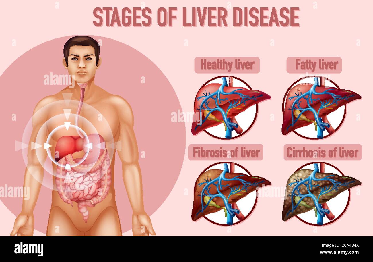 Stages of liver disease illustration Stock Vector Image & Art - Alamy