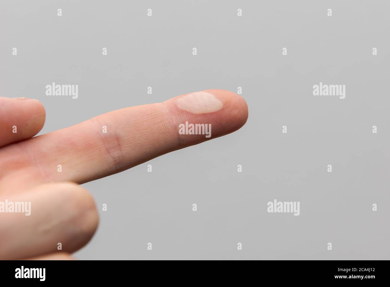 Index finger of human hand with painful blister on fingertip from touching hot pan isolated on white background Stock Photo