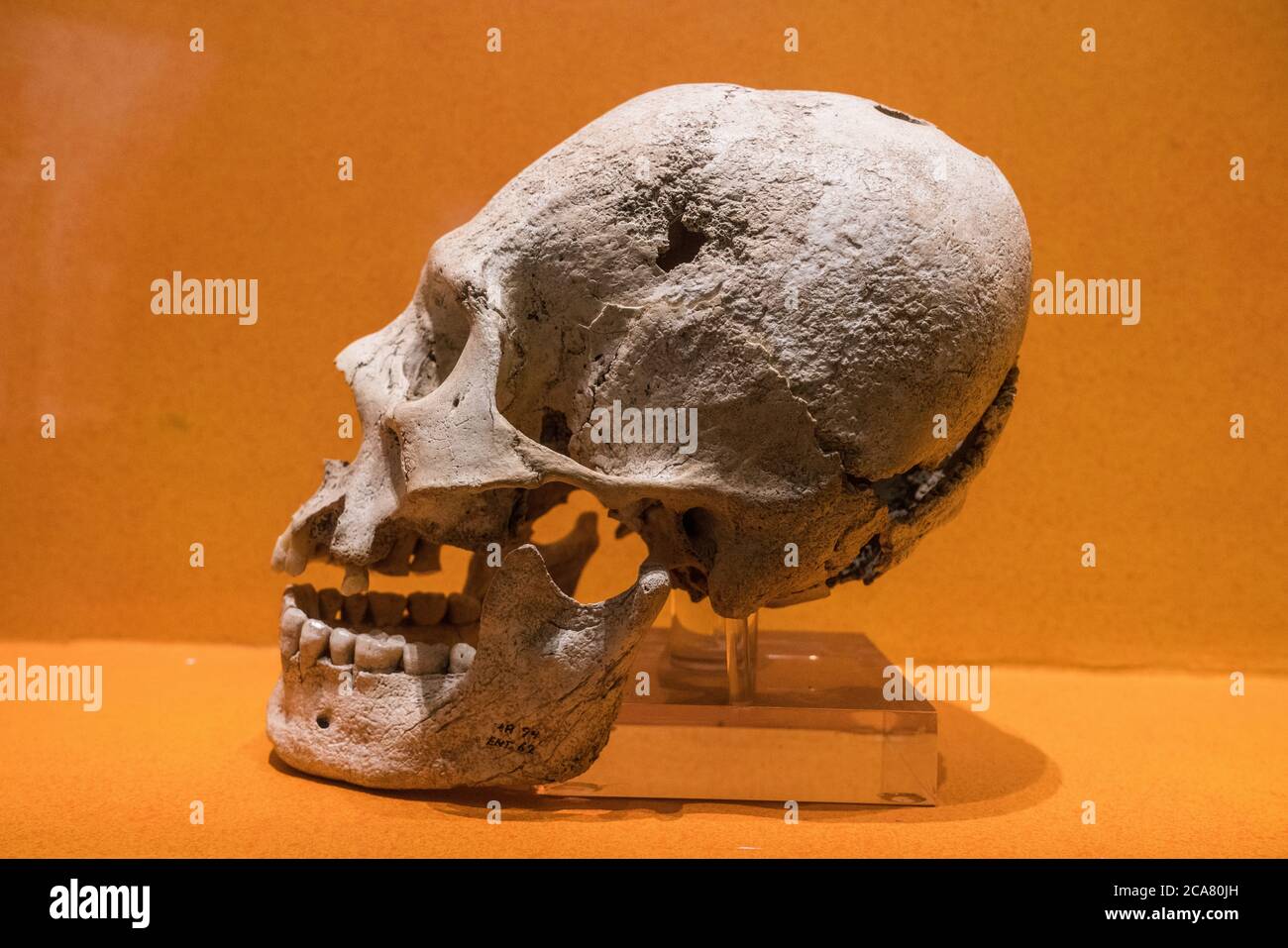 A skull from the ruins of Monte Alban showing cranial deformation and trepanation surgery.  Monte Alban Site Museum, Oaxaca, Mexico.  A UNESCO World H Stock Photo