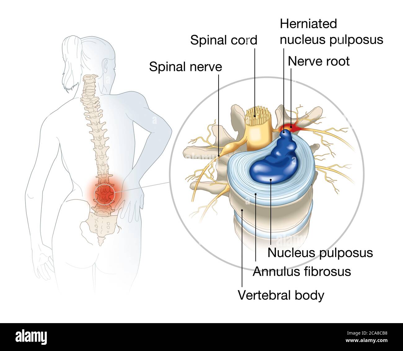 illustration showing lumbal vertebra with intervertebral disc and