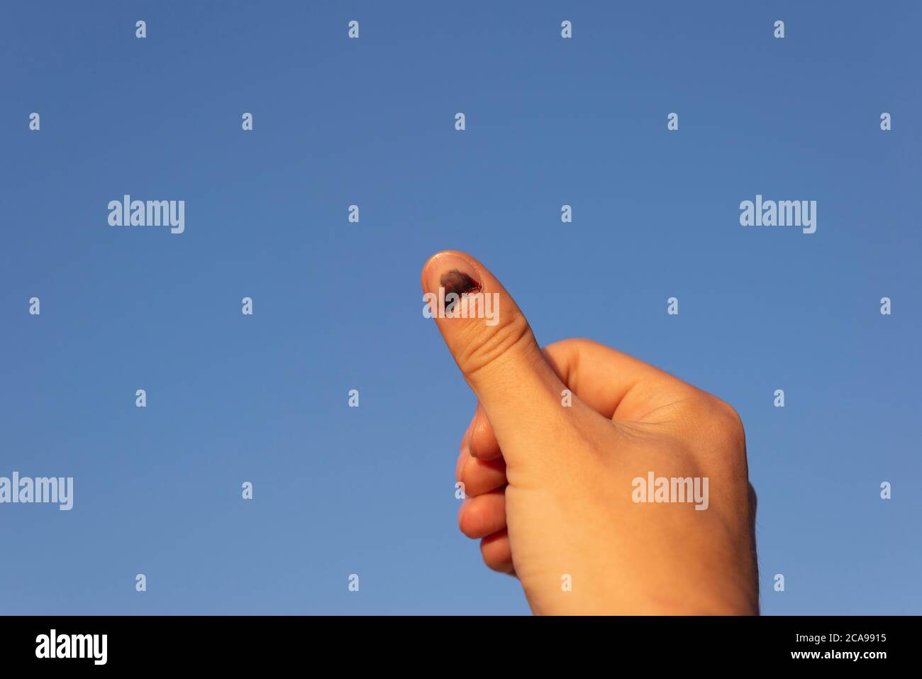 Bruised Fingernail High Resolution Stock Photography and Images - Alamy