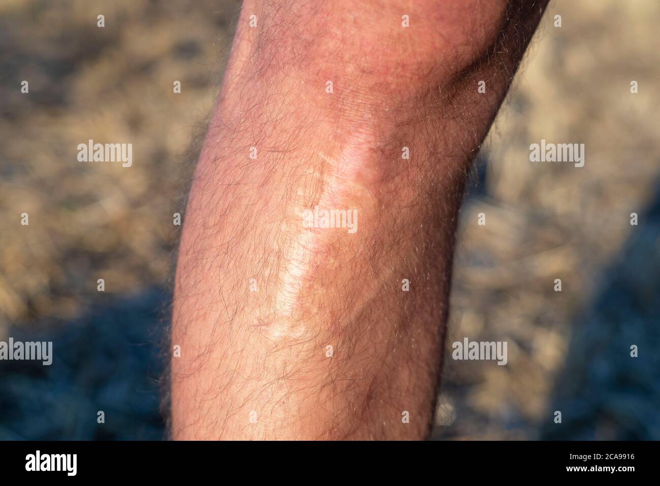 scars on his leg scar on the leg, after injury. The last stage of