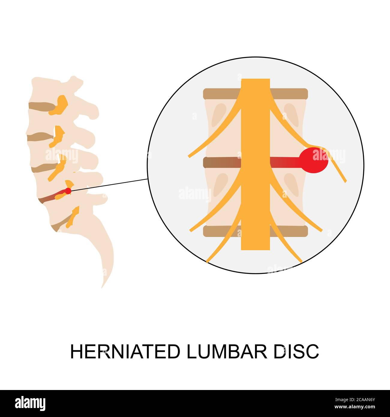 Vector illustration demonstration of human herniated lumbar disc. Lumbar disc herniation can cause low back pain and sciatica Stock Vector
