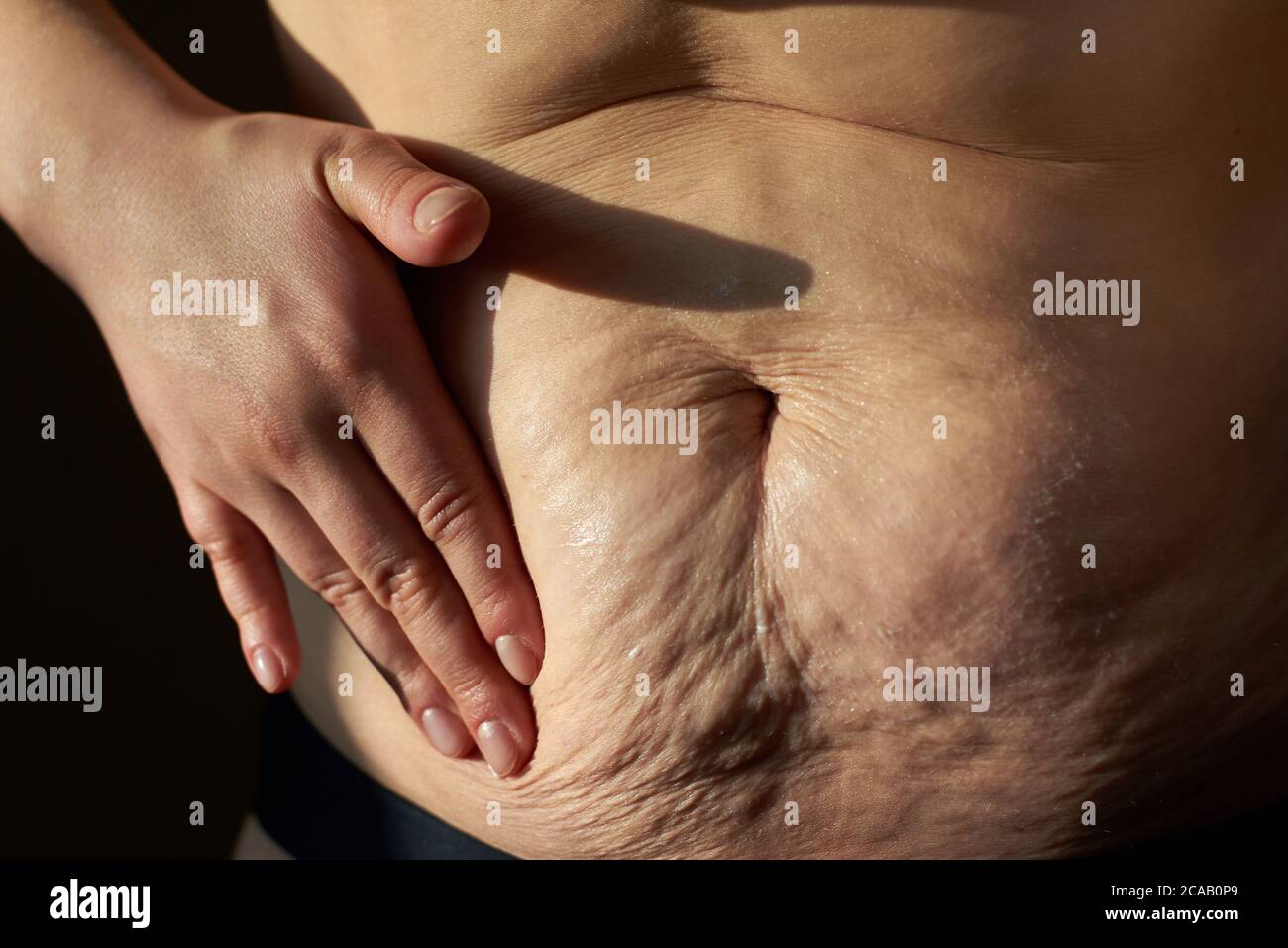 Woman smears nutritious cream sagging flabby belly with stretch marks, close-up. Stock Photo