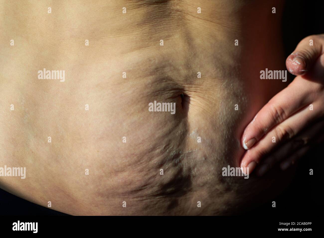 Woman smears nutritious cream sagging flabby belly with stretch marks, close-up. Stock Photo