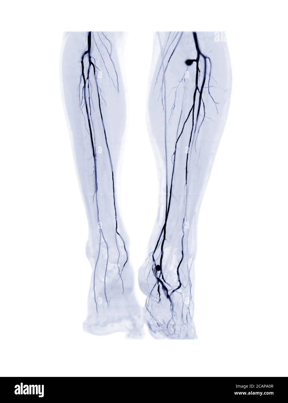 CTA femoral artery run off  3D MIP image or CTA leg for diagnosis Acute or Chronic Peripheral Arterial Disease in Diabetic patient. Stock Photo