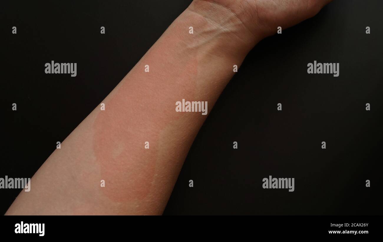 Picture of Female hand covered with red spots, close-up. Allergic reaction to an ...