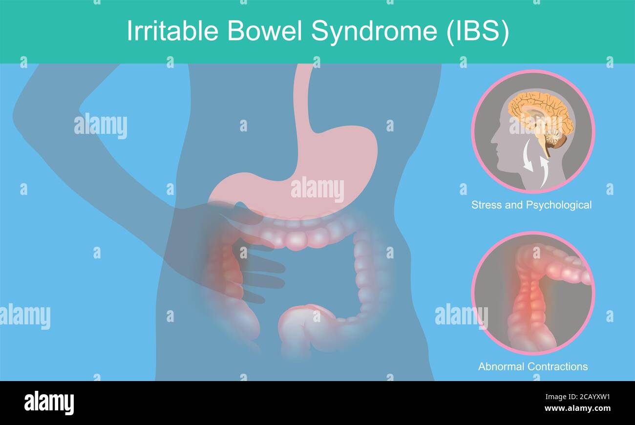 Irritable Bowel Syndrome. Illustration explain abnormal contractions and pain perception human bowel as a result of the brain stress responses. Stock Vector