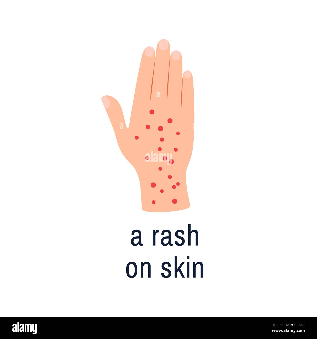 Skin rash icon isolated on white Allergy hand palm Stock Vector