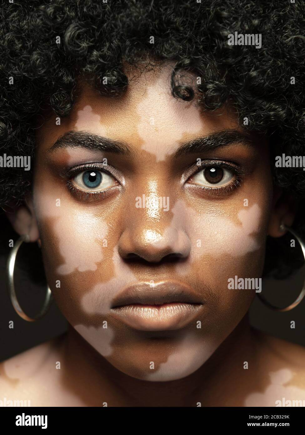 Portrait of african-american woman with vitiligo skin. Special skin with  depigmentation because of melanin losing. Concept of skincare and  healthcare, inclusion and diversity, fashion and beauty Stock Photo - Alamy