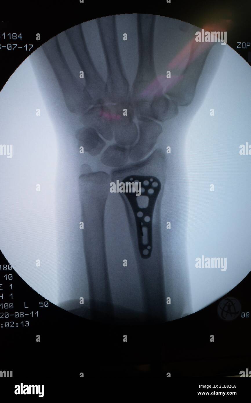 an X-ray shows a wrist with a titanium plate Stock Photo