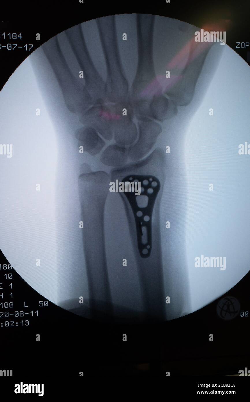 X ray of a broken arm hires stock photography and images Alamy