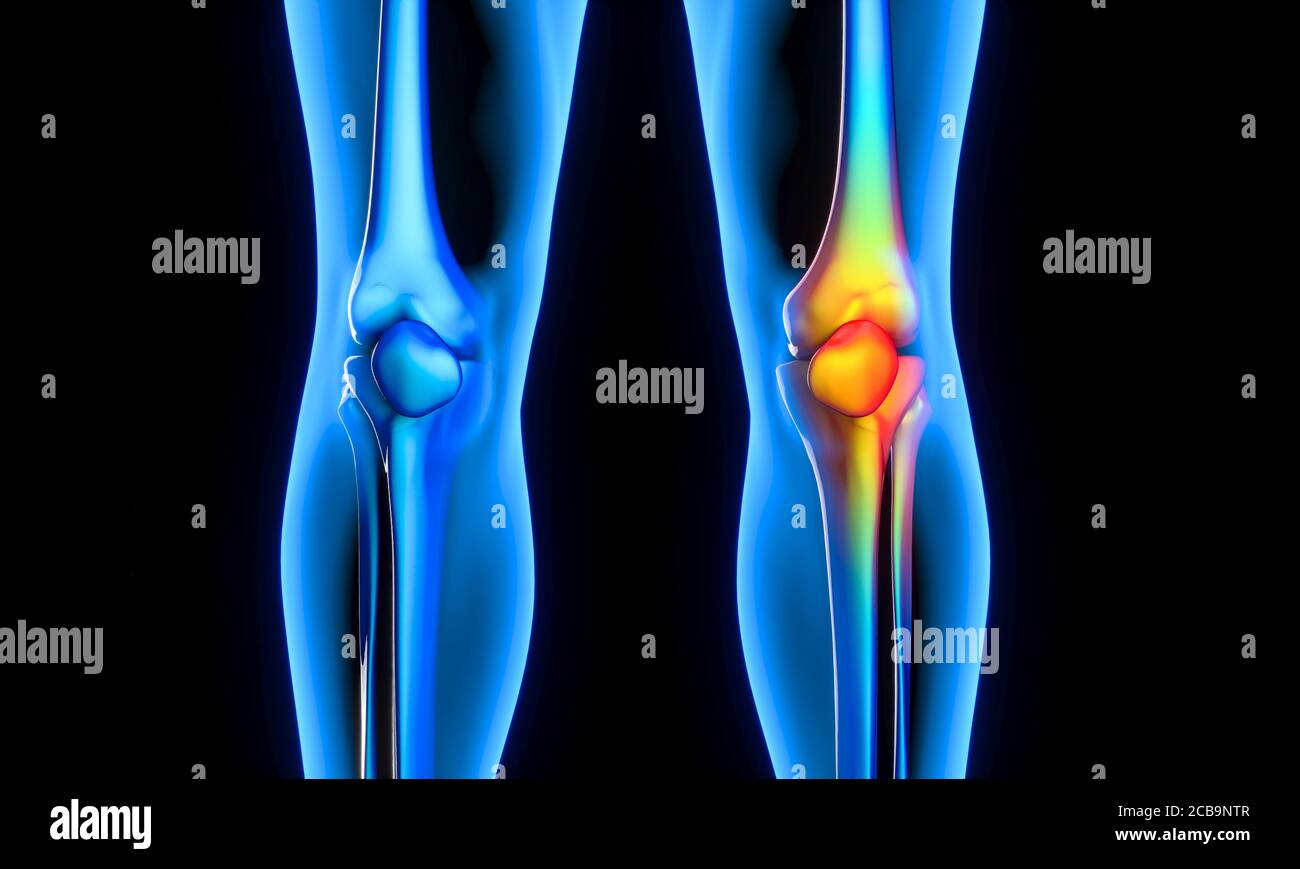 sore knee, medicine and health concept, discomfort. 3d render. Stock Photo