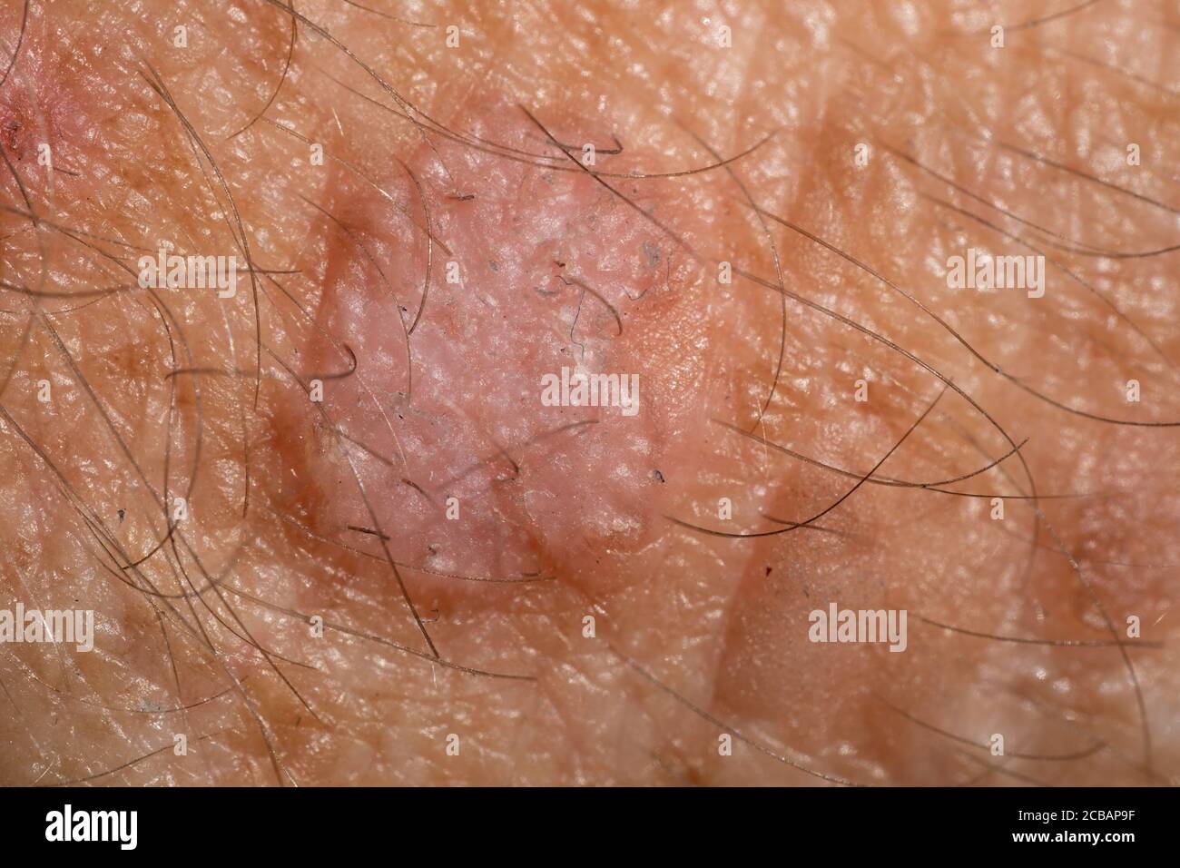 Close up of a lesion of actinic keratosis or sunspots on sun-damaged skin of the hand of a man. This can be treated with cryosurgery or ointments Stock Photo