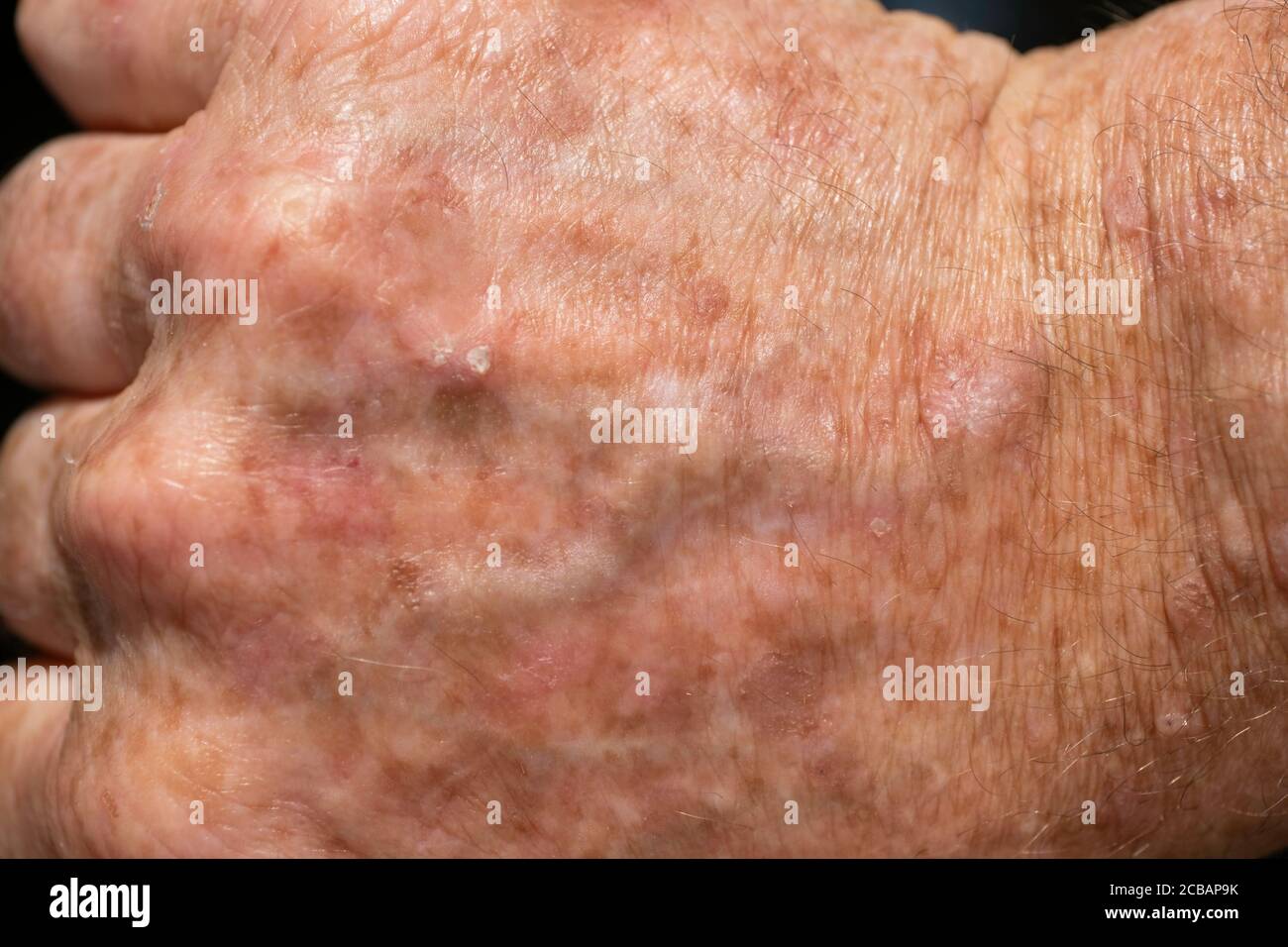 Close up of a lesion of actinic keratosis or sunspots on sun-damaged skin of the hand of a man. This can be treated with cryosurgery or ointments Stock Photo