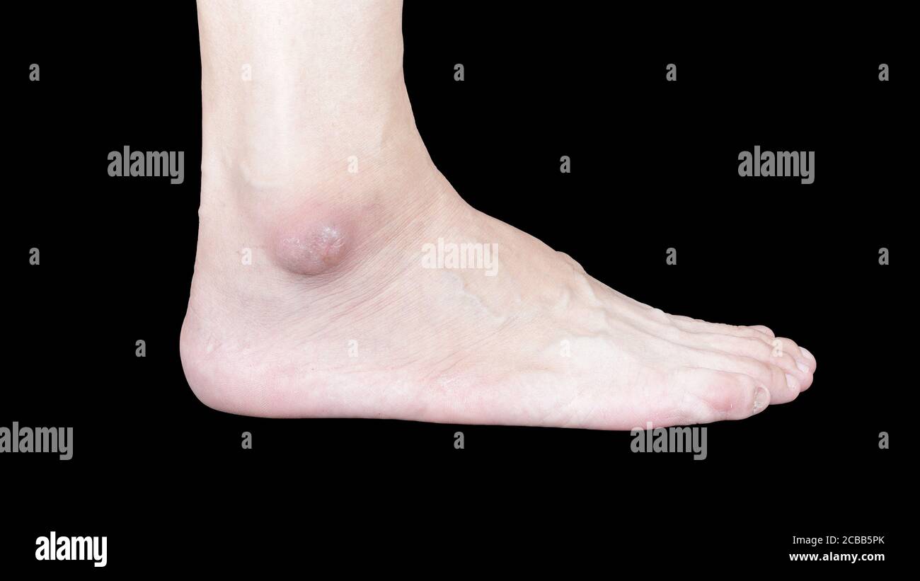 The image of the right foot where the astragalus is swollen, matte and black due to inflammation. Stock Photo