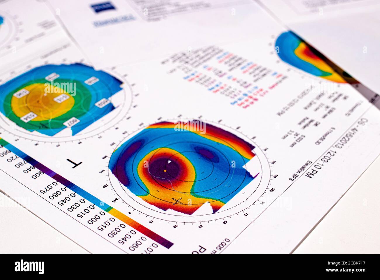 25.07.2020, Zarorizhzhya. Topography of the cornea of the eye, layout. Keratoconus of the right eye is 3rd degree and the left eye is 2 degrees. Stock Photo