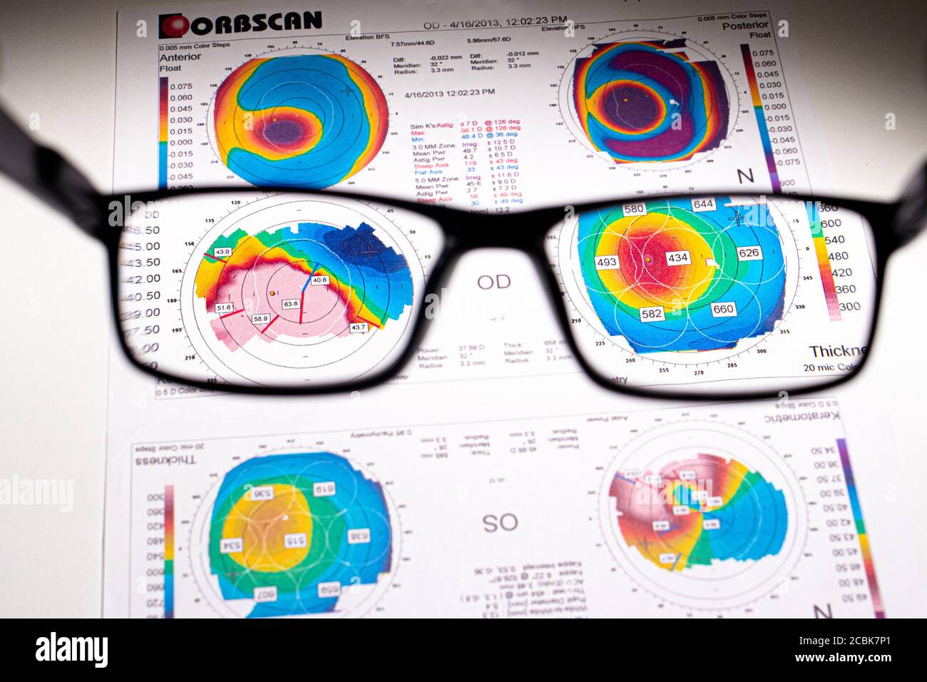 25.07.2020, Zarorizhzhya. Topography of the cornea of the eye, layout. Keratoconus and glasses. Keratotopography - ophthalmological examination. Stock Photo