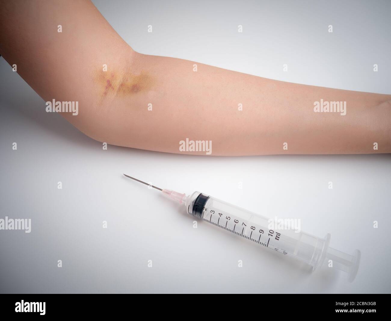 syringe , injection needle on the table and close up arm with bruise effect from frequent injection Stock Photo