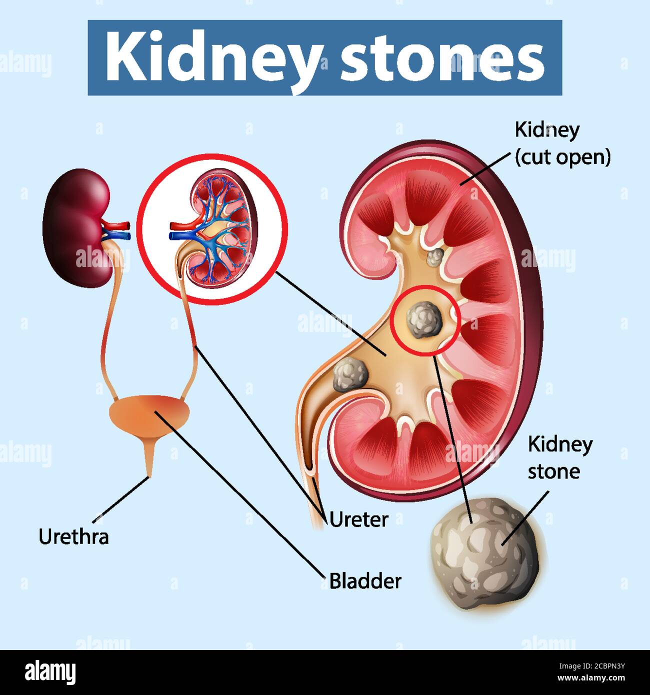 Informative illustration of kidney stones illustration Stock Vector Image & Art Alamy