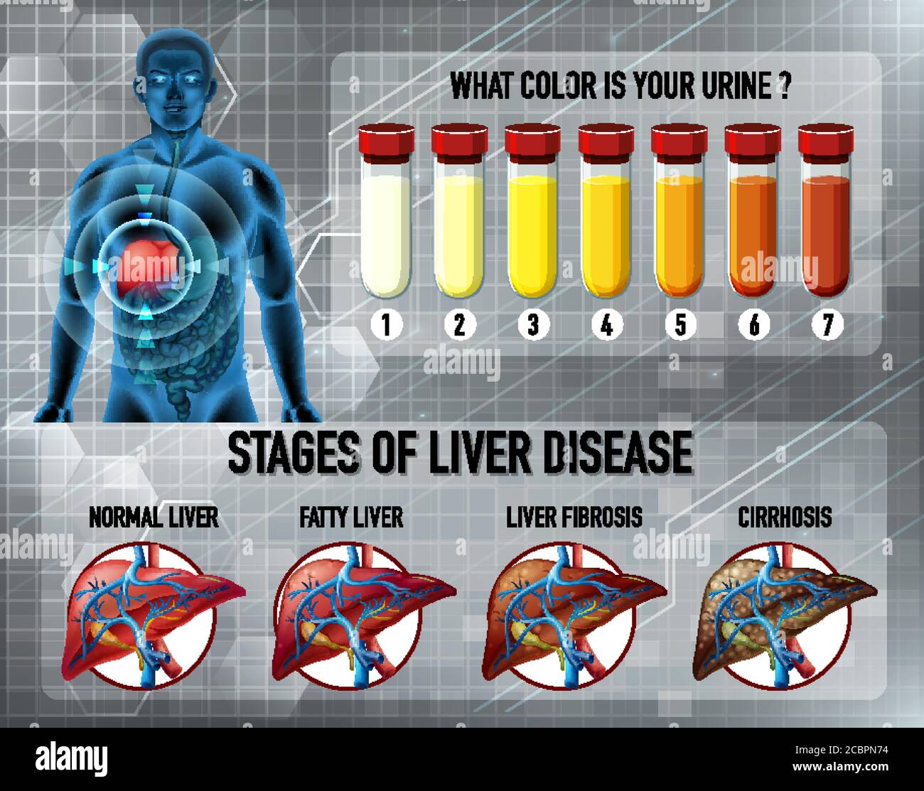 Stages Of Liver Disease Illustration Stock Vector Image And Art Alamy