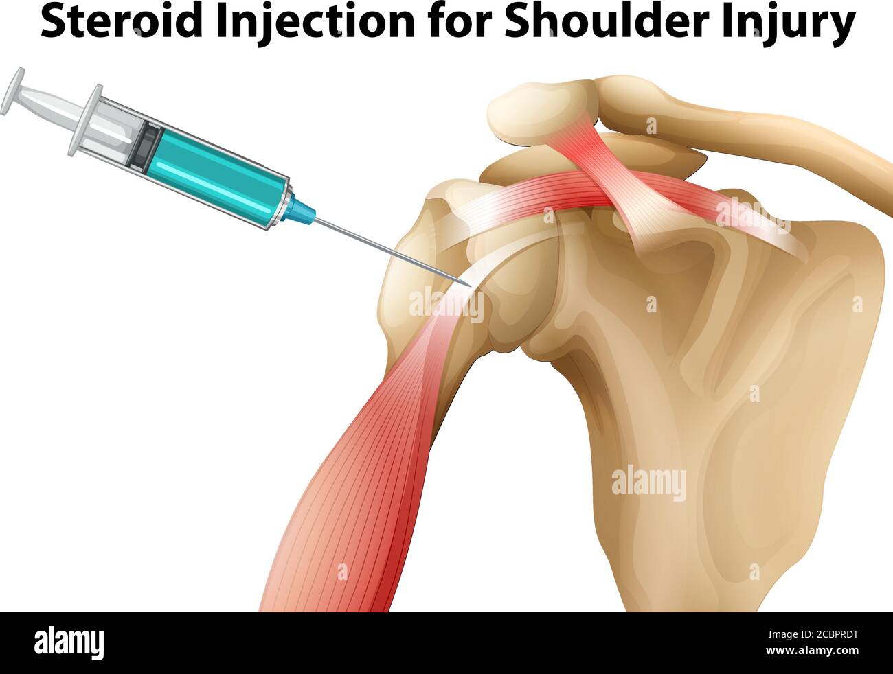 Steroid Injection for Shoulder Injury illustration Stock Vector Image