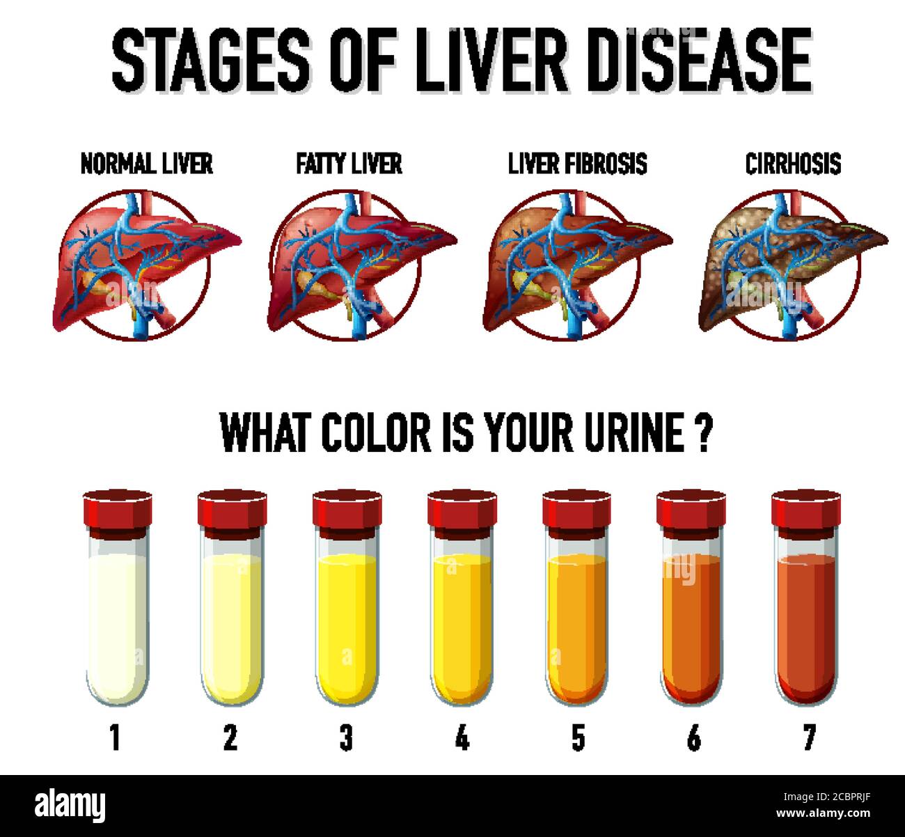Stages of liver disease illustration Stock Vector Image & Art Alamy