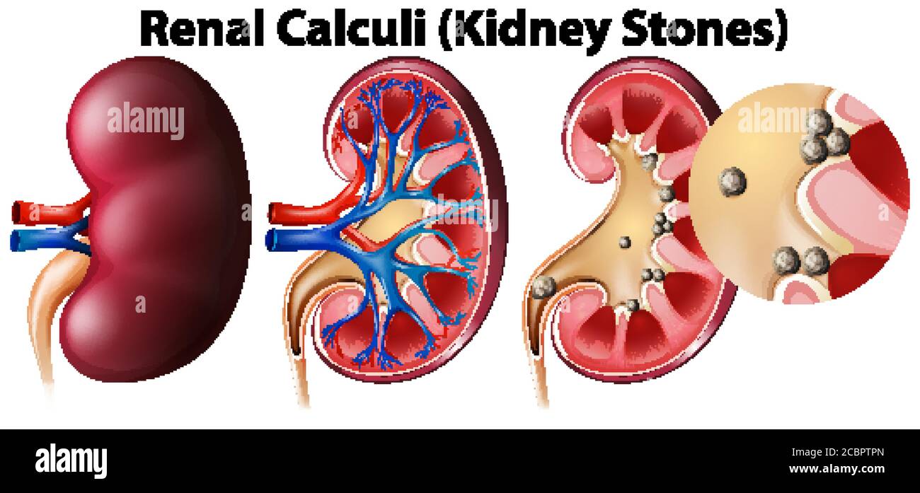 Anatomy of kidney and kidney stones illustration Stock Vector Image
