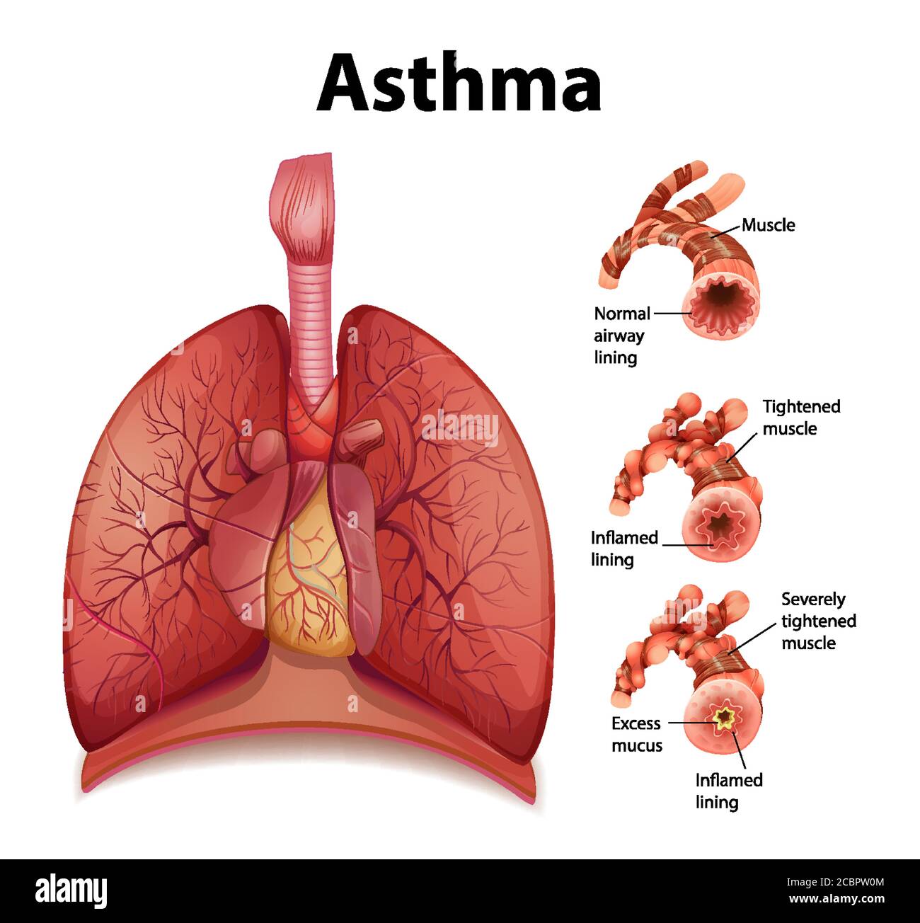 Comparison Of Healthy Lung And Asthmatic Lung Illustration Stock Vector