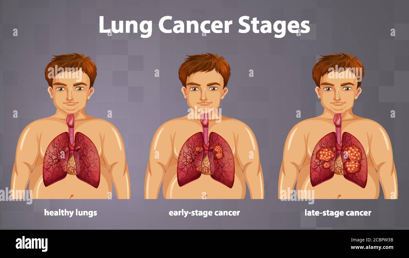 Informative illustration of lung cancer stages illustration Stock Vector Image & Art Alamy