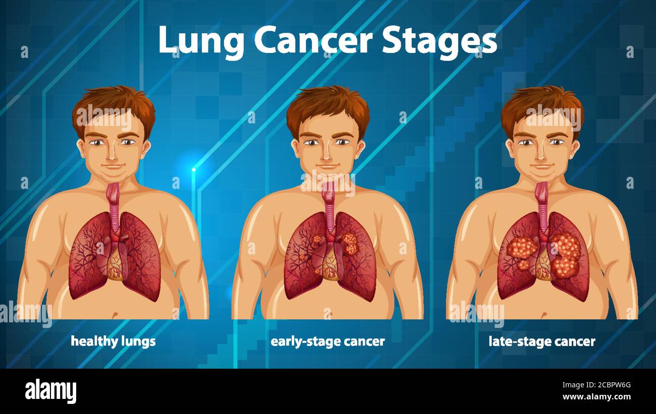 Informative illustration of lung cancer stages illustration Stock ...