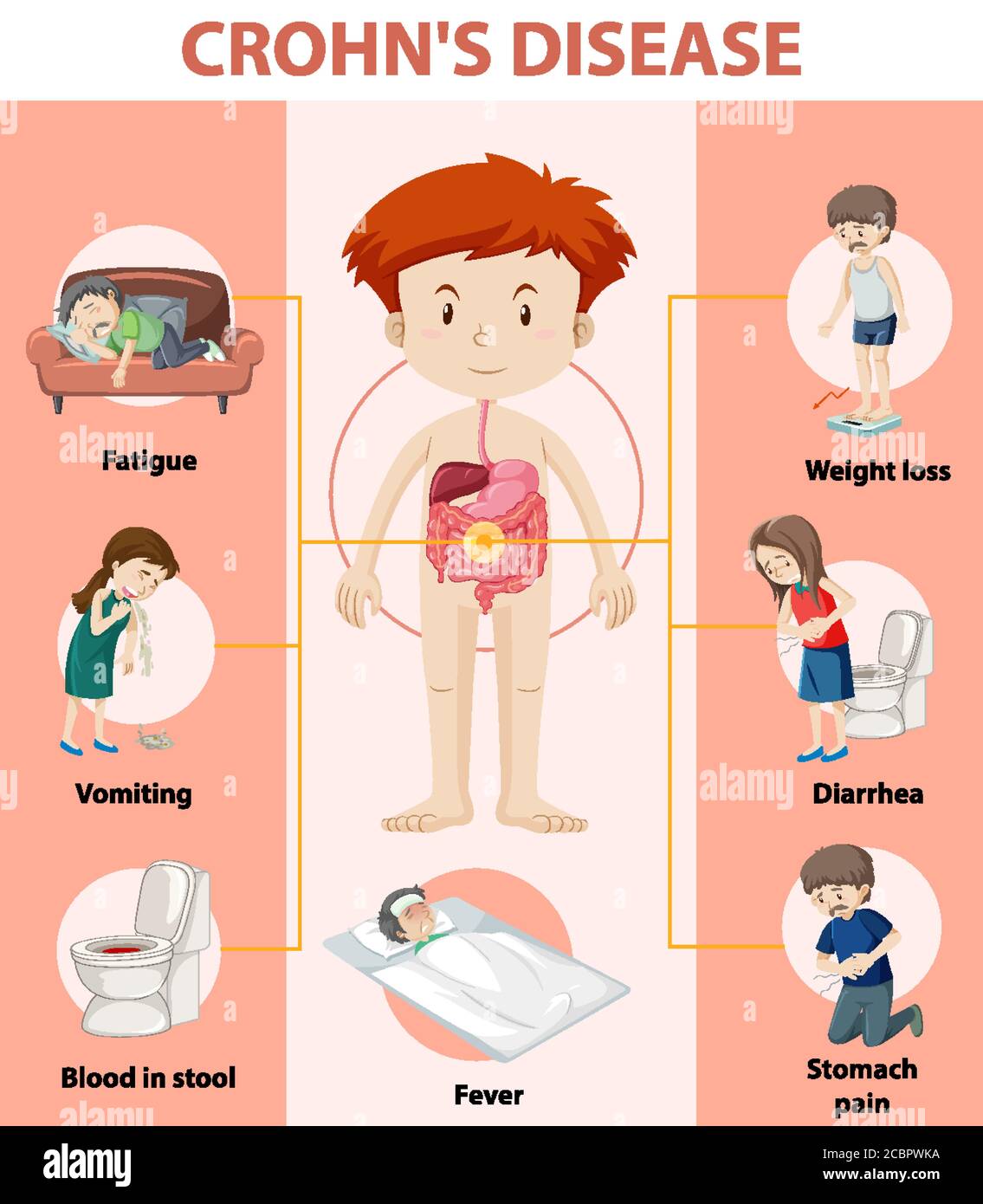 Medical infographic of Crohn's Disease illustration Stock Vector Image ...