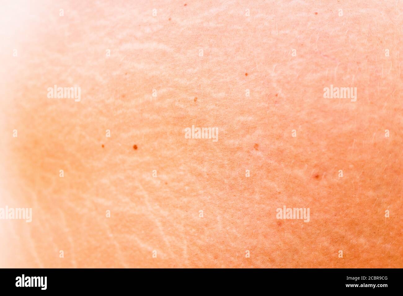 Stretch marks on the skin of a middle-aged woman, detail. Stock Photo