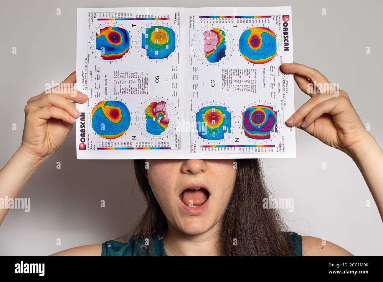 Thinning corneal dystrophy, eye keratotopography. Stock Photo