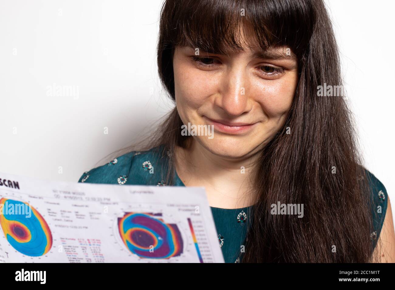 Thinning corneal dystrophy, eye keratotopography. Stock Photo
