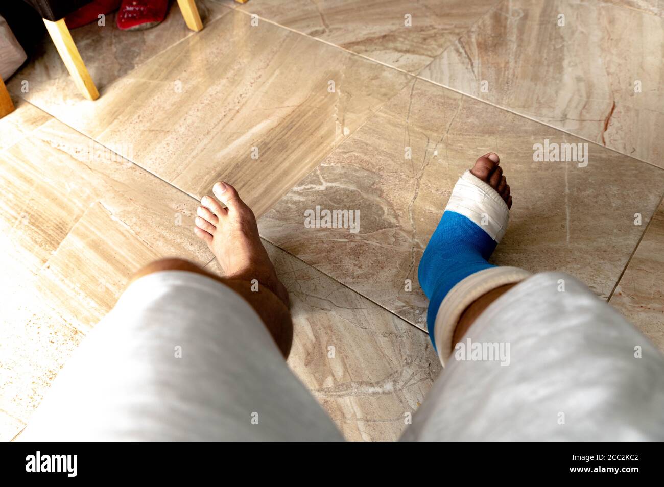 Man in cast after surgery on foot sat on chair Stock Photo