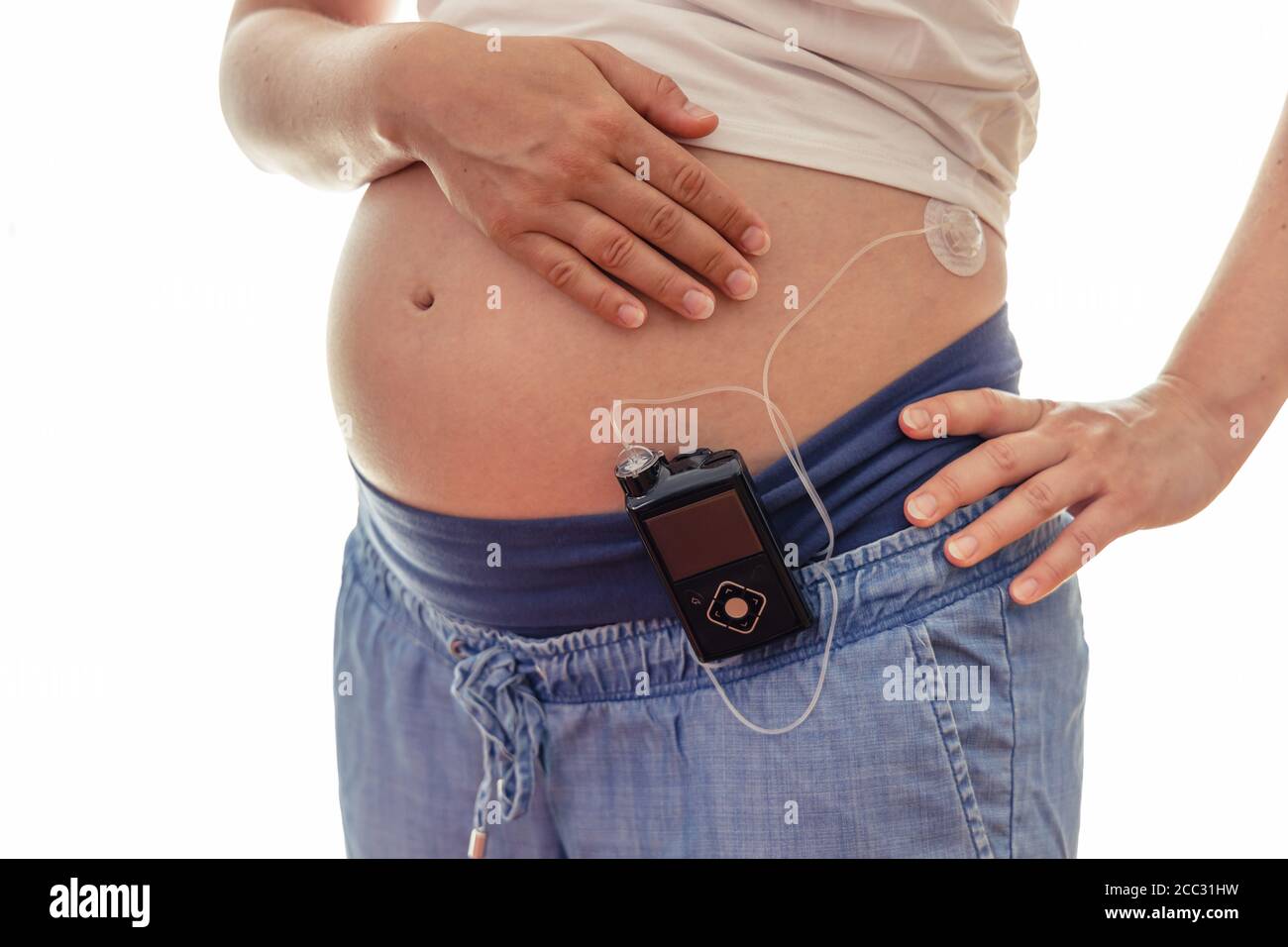 Pregnant woman with insuline pump on her pants and drainage mounted on her belly. Modern