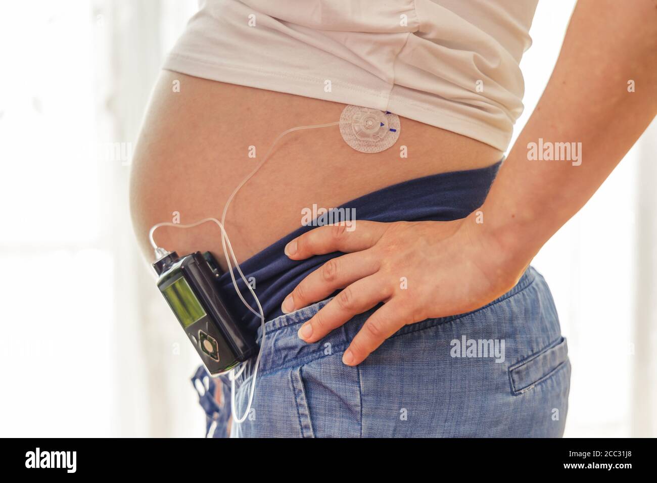 Pregnant woman with insuline pump on her pants and drainage mounted on
