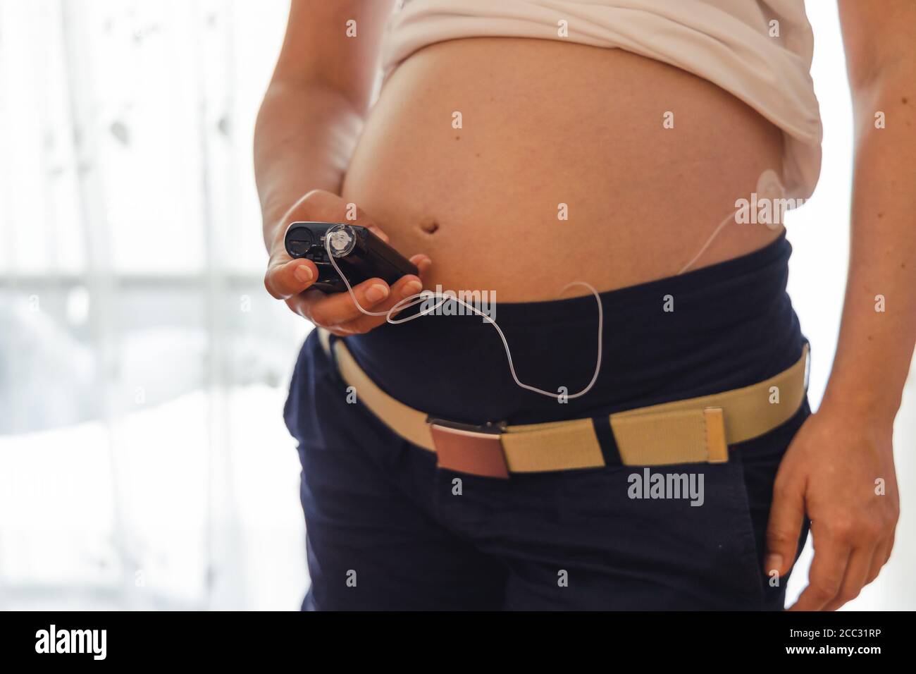 Pregnant woman operates insuline pump. Modern diabetes treatment through insulin given by a