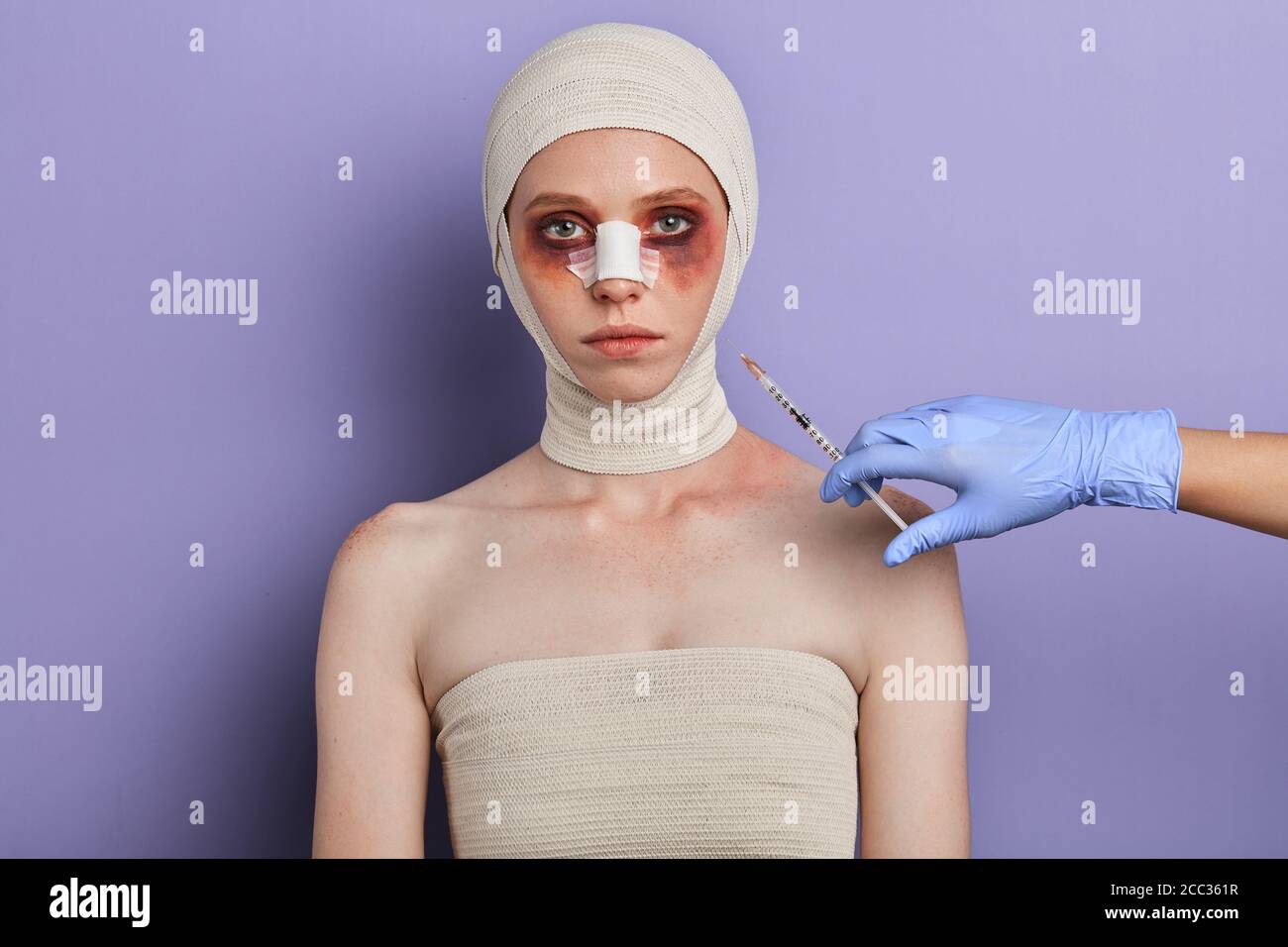young woman with bruises does injection to nasolabial fold, close up portrait, isolated blue background, studio shot.lifestyle, treatment Stock Photo