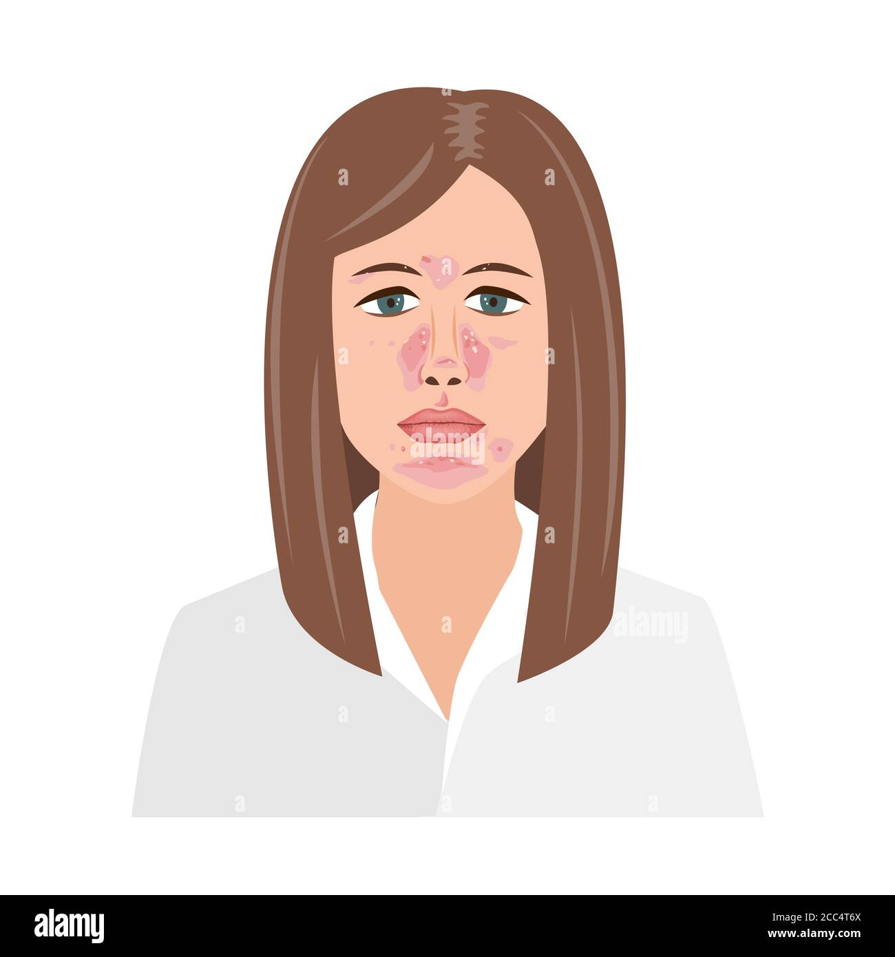Unhappy Woman Suffering from Seborrheic Dermatitis. Vector illustration. Adult or teenager face with skin problems isolated white background Stock Vector