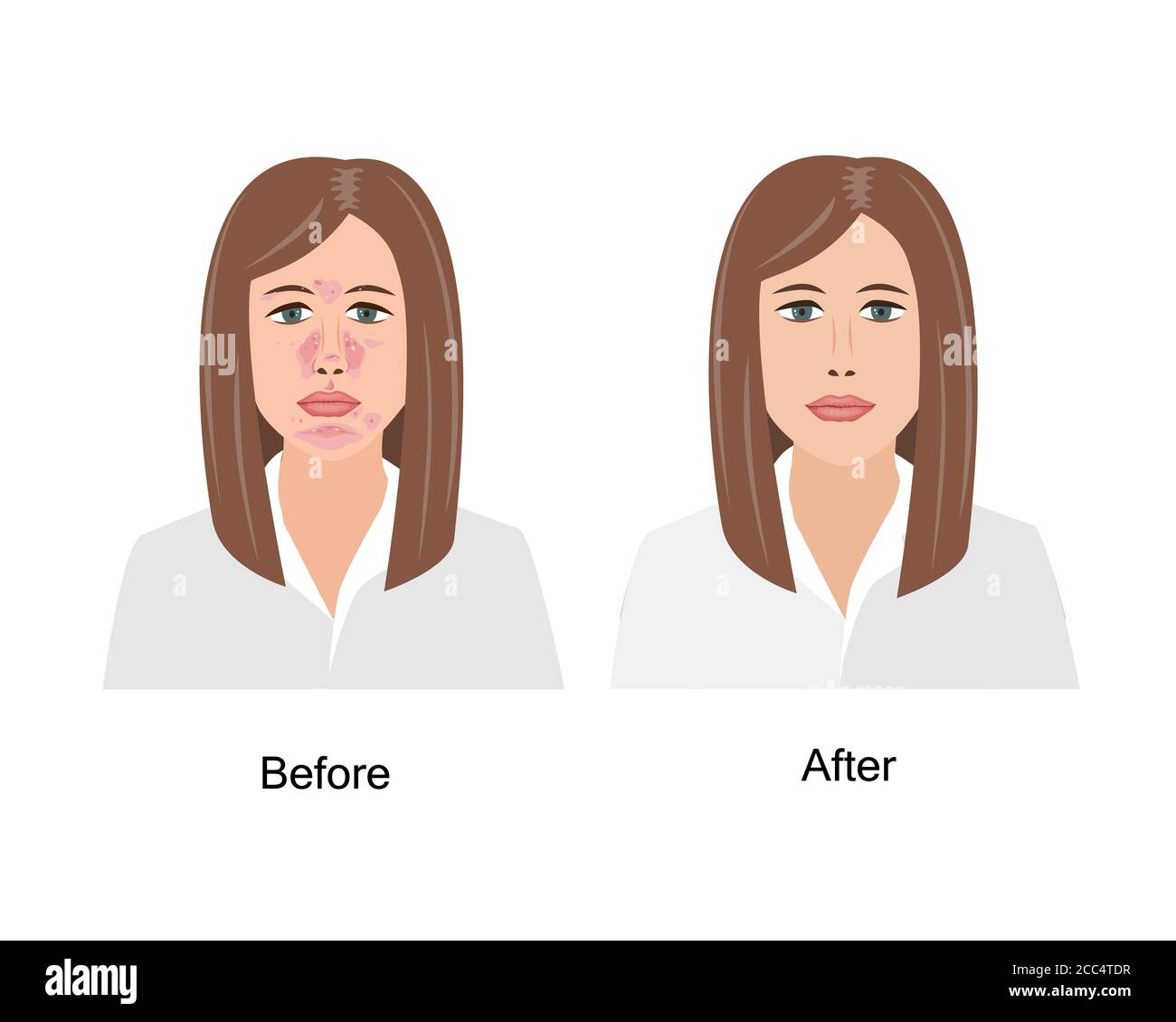 Woman Suffering from Seborrheic Dermatitis before and after medical treatment. Vector illustration. Adult or teenager face with skin problems isolated Stock Vector
