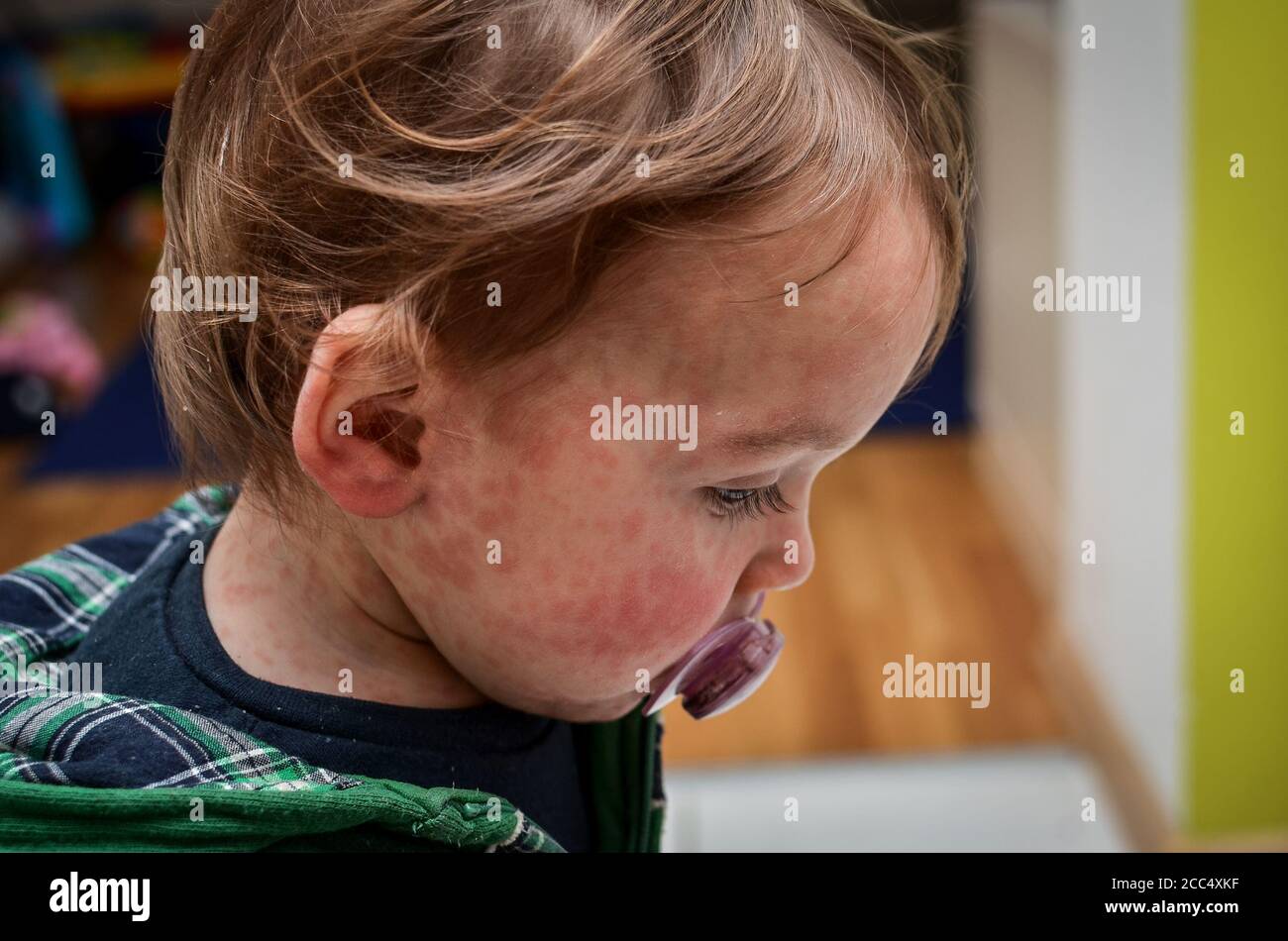 Children viral disease or allergies. Red measles rash on baby. Child with viral children disease