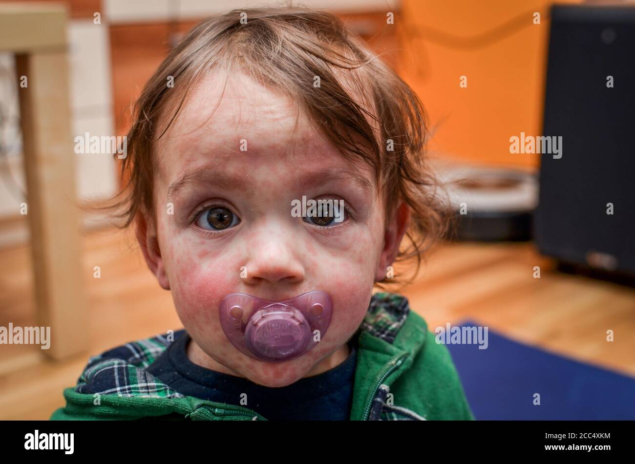 Children viral disease or allergies. Red measles rash on baby. Child with viral children disease