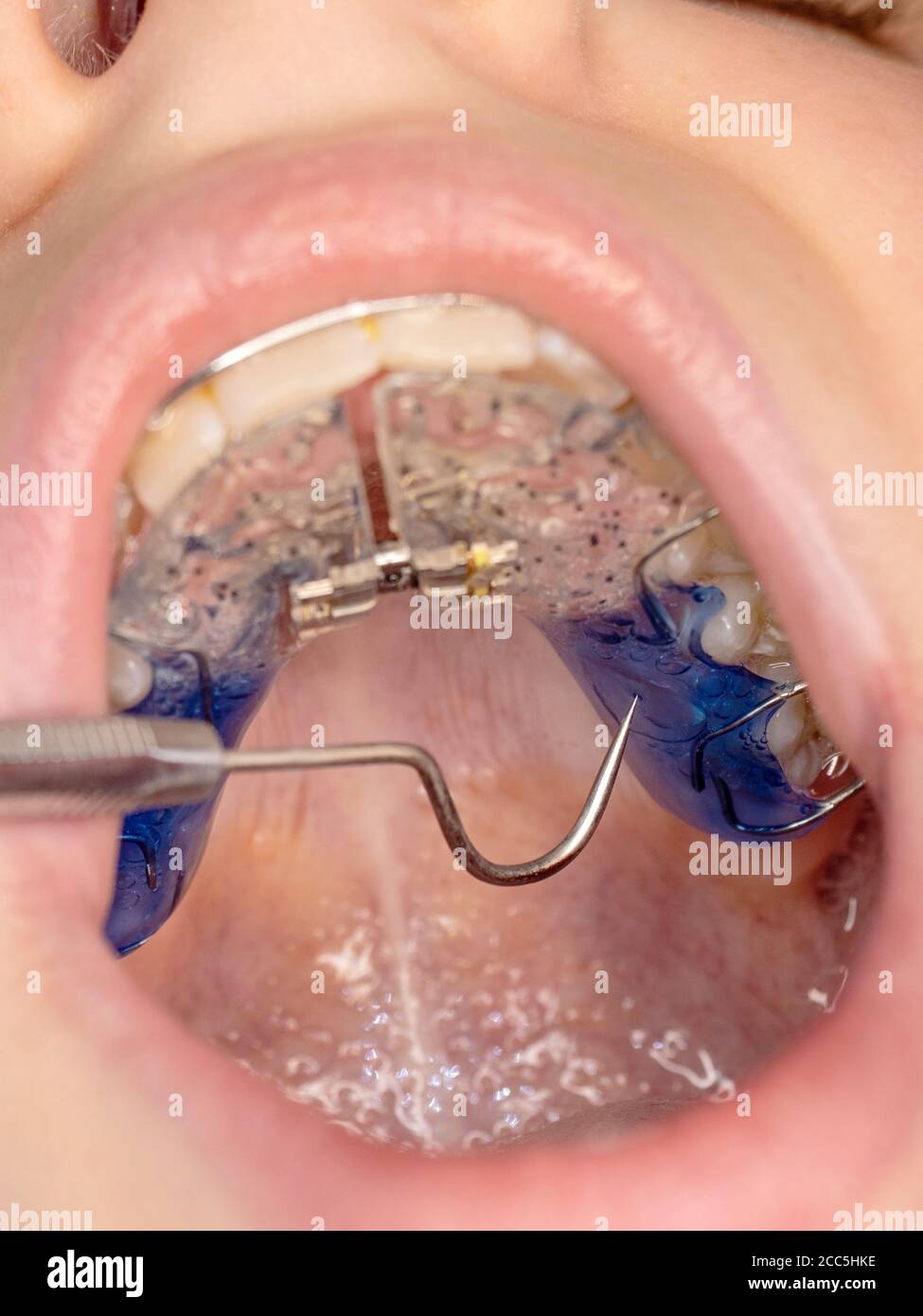 Dentist checking bracket at the braces on the kid patient. Close-up. Real People. Stock Photo