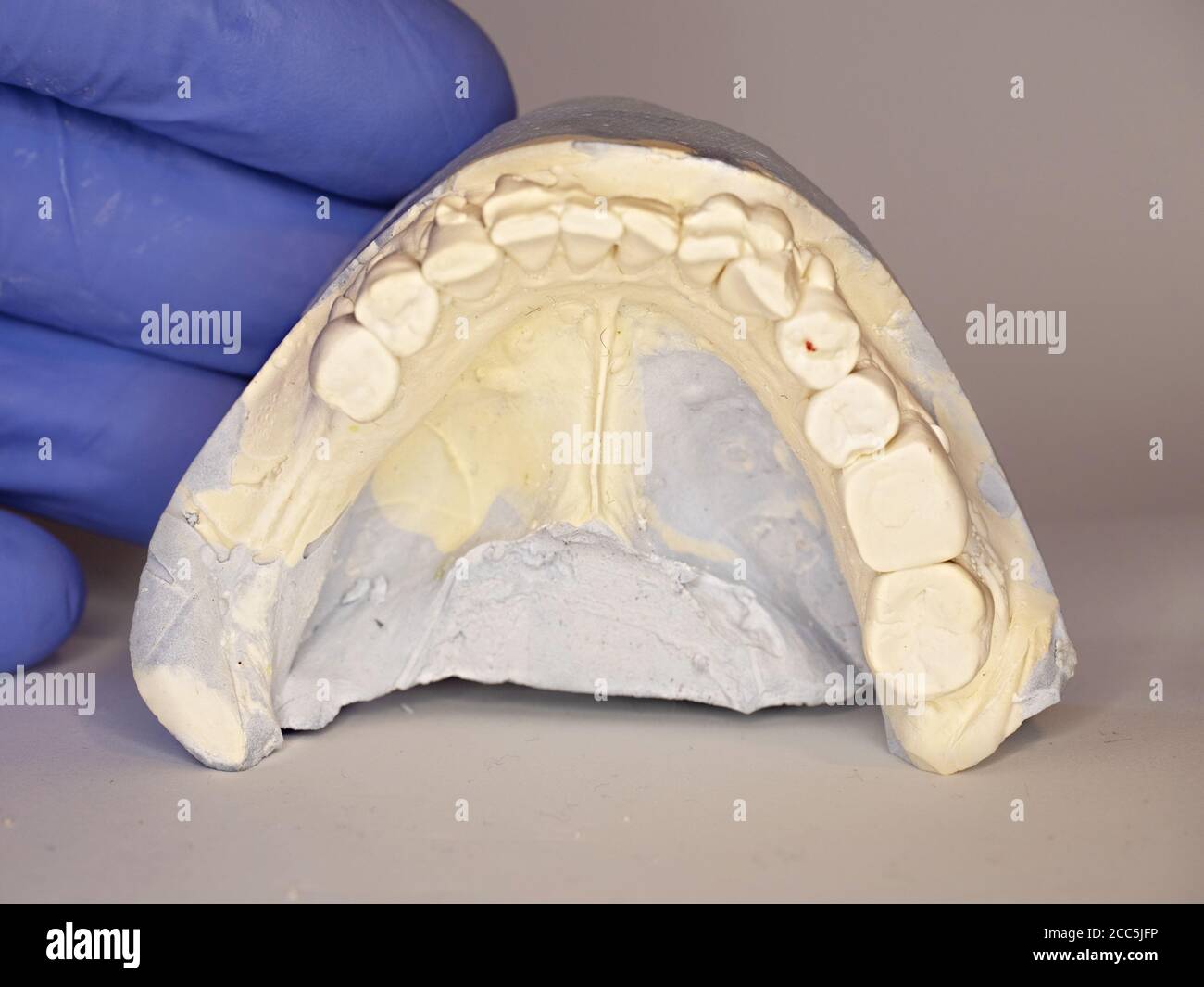 Molding dentist material. Cast model showing tooth decay in dental