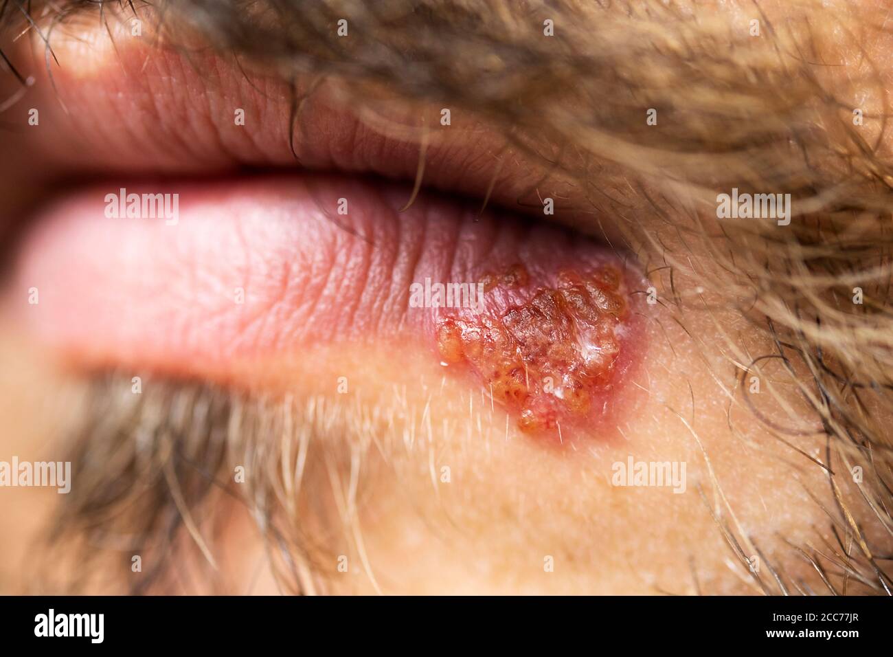 Close up shot of herpes on the lips. Stock Photo