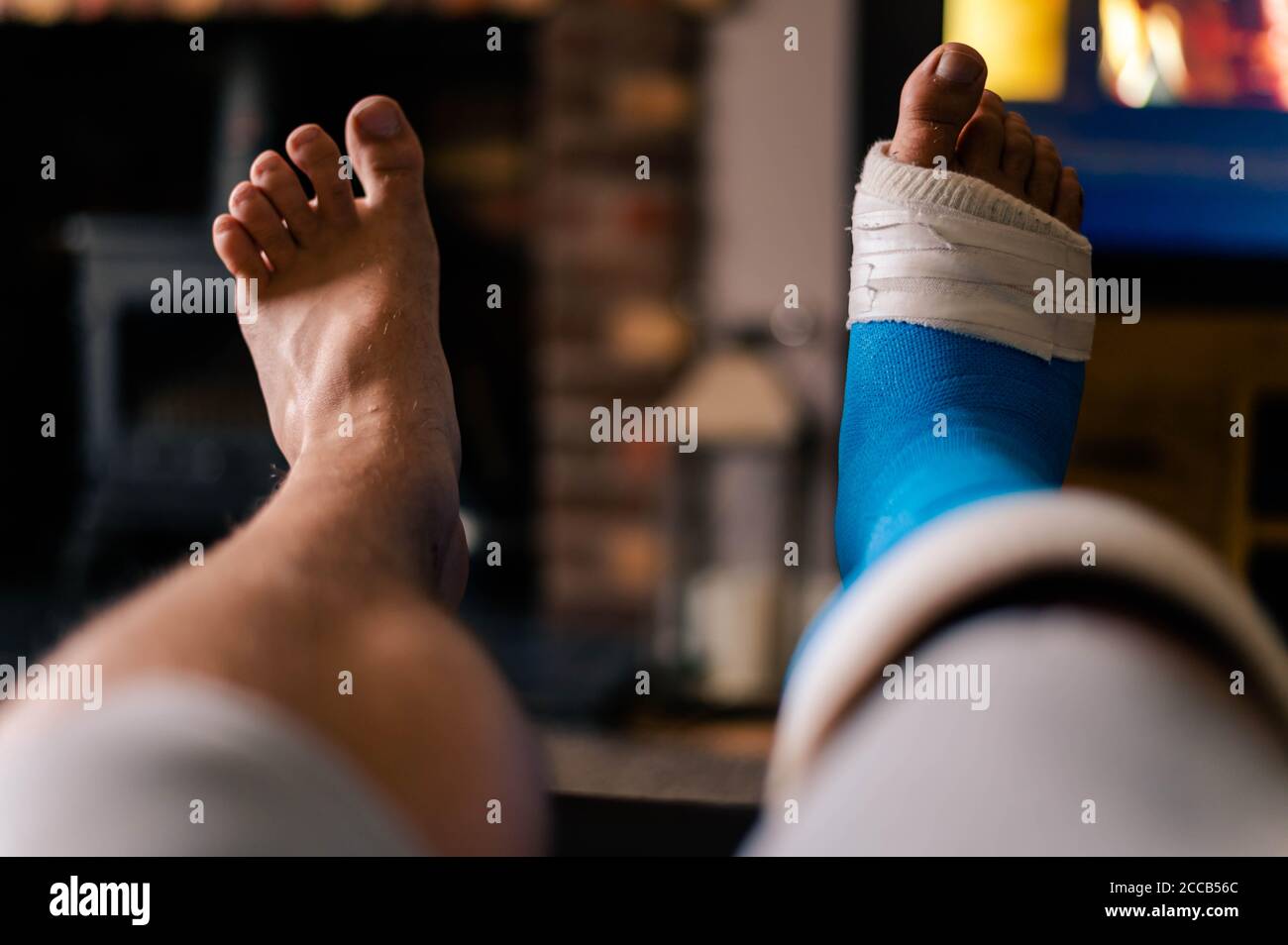 Male resting cast on chair elevated from foot surgery.fifth metatarsal surgery. Stock Photo