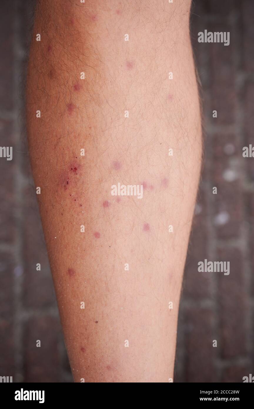 Red mites hires stock photography and images Alamy